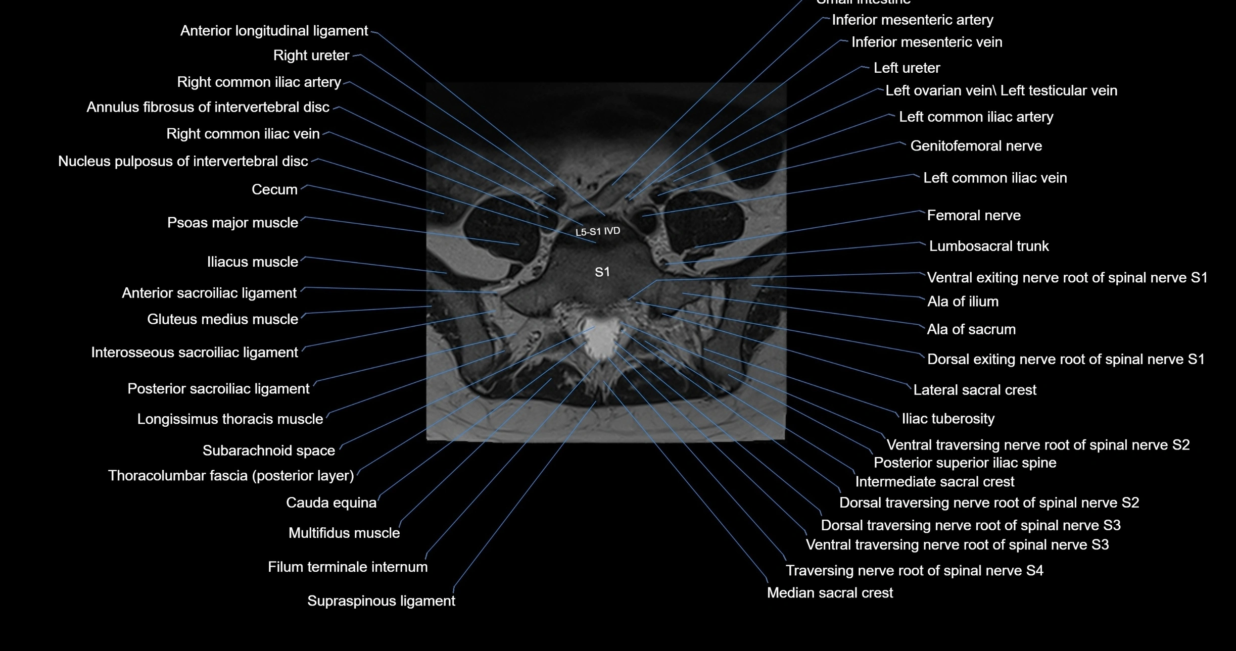 MRI lumbar spine axial cross sectional anatomy 3T radiology  image-img-00001-00044.webp